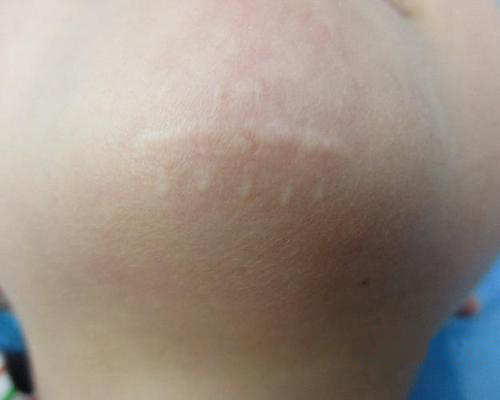 疤痕性白斑是白癜风吗,继发性白癜风和白癜风有什么区别