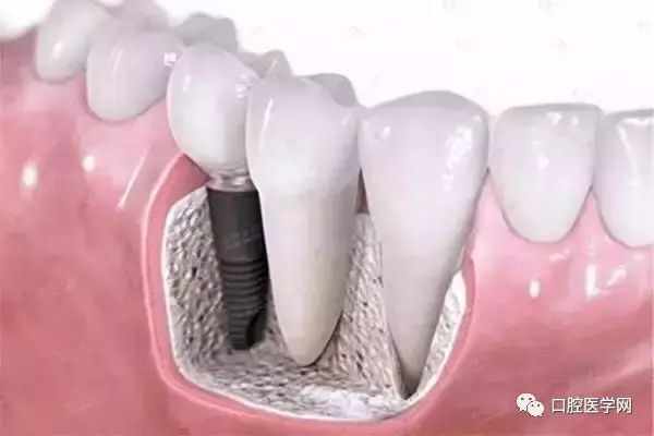 缺牙不镶牙你不知道的危害,缺牙不镶牙的不良影响示意图