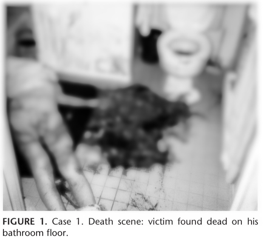 静脉大出血是怎么回事,肝硬化胃部静脉曲张导致大出血