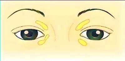 眼角长黄色肉疙瘩，是怎么回事？医生提醒：可能血脂有异常！