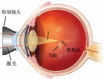 有飞蚊症眼睛睁开一瞬间有黑点,飞蚊症是黑色的圈圈吗