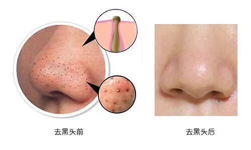 老年人黑头粉刺去除,手挤黑头的去除过程