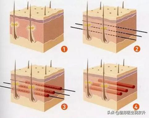 40岁-50岁上下，对抗面部松弛这些“弯路”请绕行？