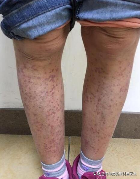 秋冬季怎样预防过敏性紫癜复发,过敏性紫癜什么情况下可以自愈