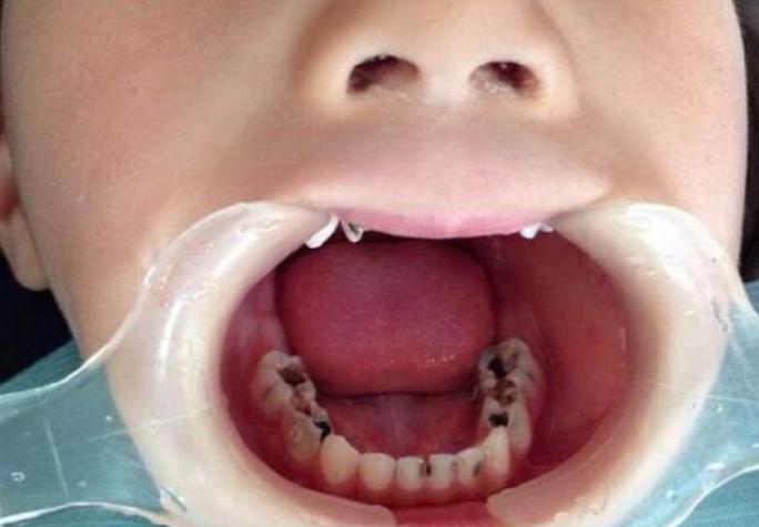 6岁小朋友换牙门牙太大,换牙小知识大全