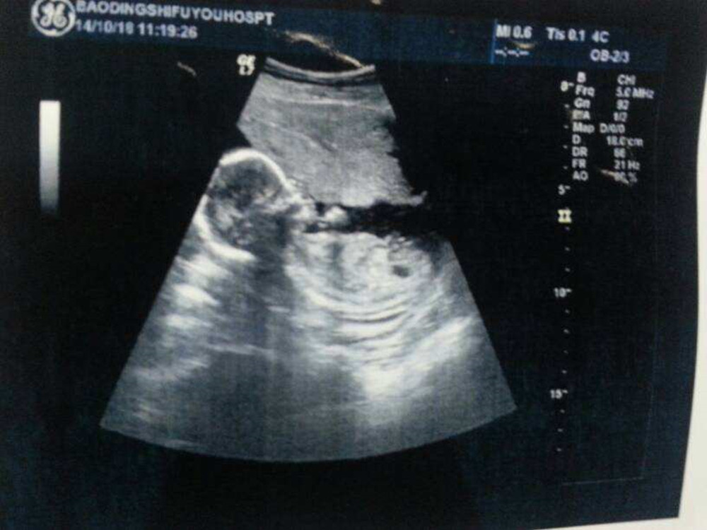 左边规律的胎动说明宝宝在干嘛,胎动在左侧代表胎宝宝在做什么