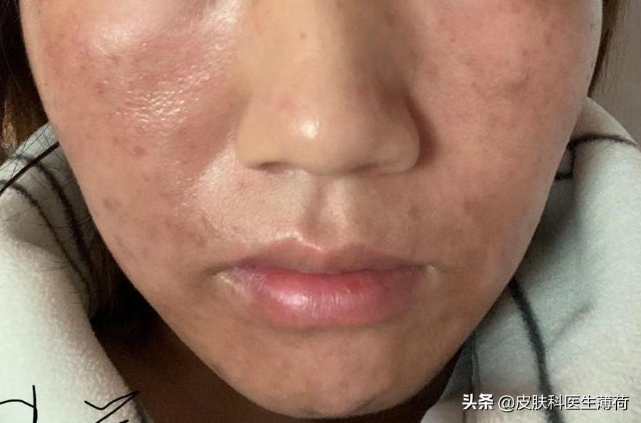 果酸换肤医生讲解,医生不会告诉你的秘密水杨酸