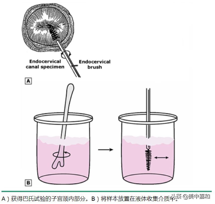 tct和hpv哪个对宫颈癌检测更准确,防宫颈癌检查hpv还是tct