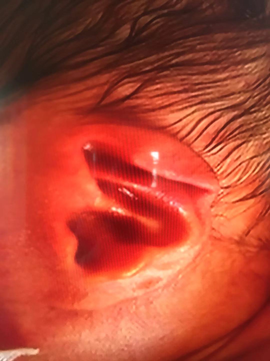 耳朵软骨畸形能矫正吗,新生儿耳朵畸形矫正费用大概多少