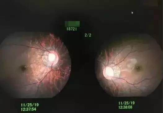 5岁男孩近视100度还能恢复吗,五岁男娃1000度近视