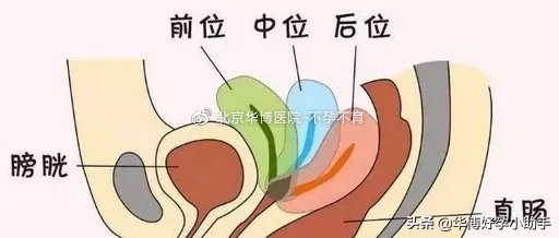 有子宫后位的容易怀孕吗,子宫后位是比较难孕吗