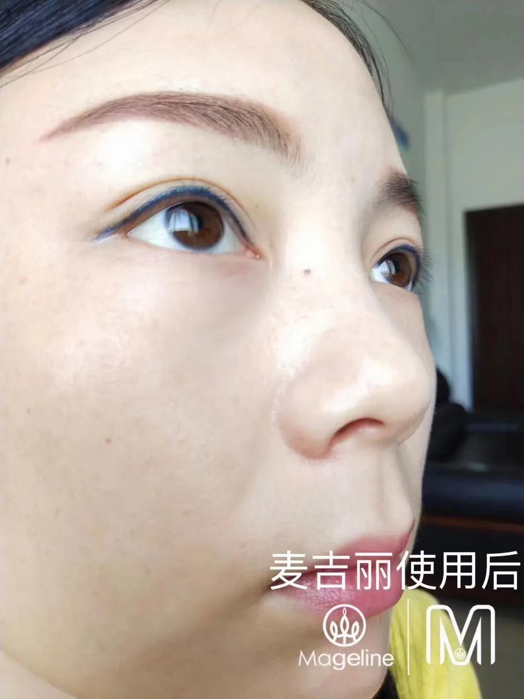 甜甜专业祛斑祛痘,甜甜祛斑直播间