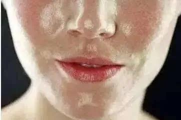 皮肤油毛孔粗大,油痘肌黑头毛孔粗大