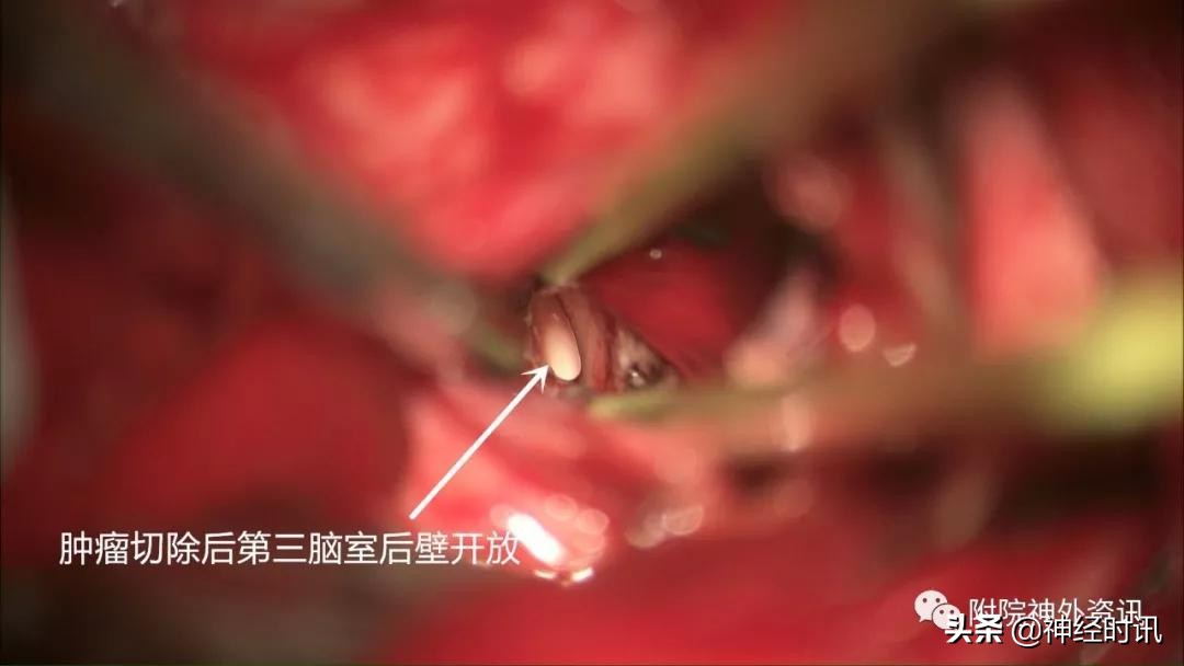 松果体占位怎样治疗,松果体区占位看什么科室