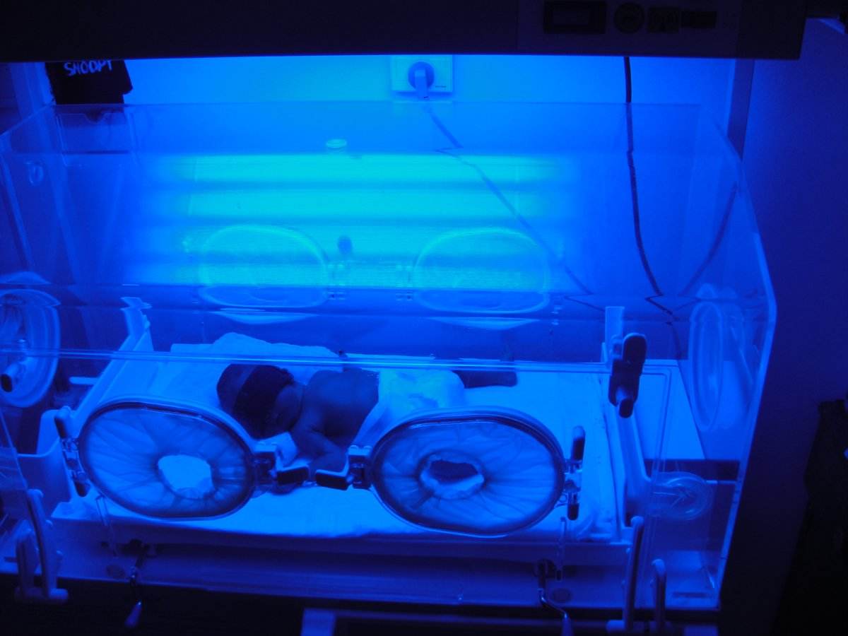 新生儿黄疸多少就该照蓝光,新生儿黄疸超过多少才需要照蓝光