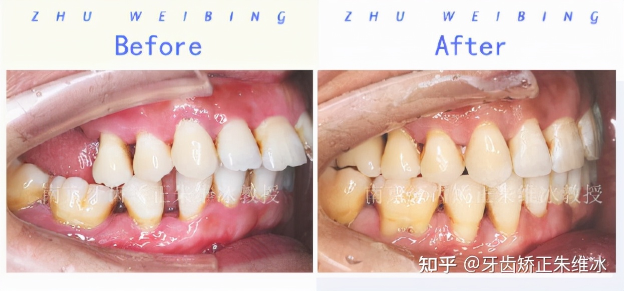 南京牙齿矫正龅牙前突要多少钱,36岁牙周不好龅牙能整吗