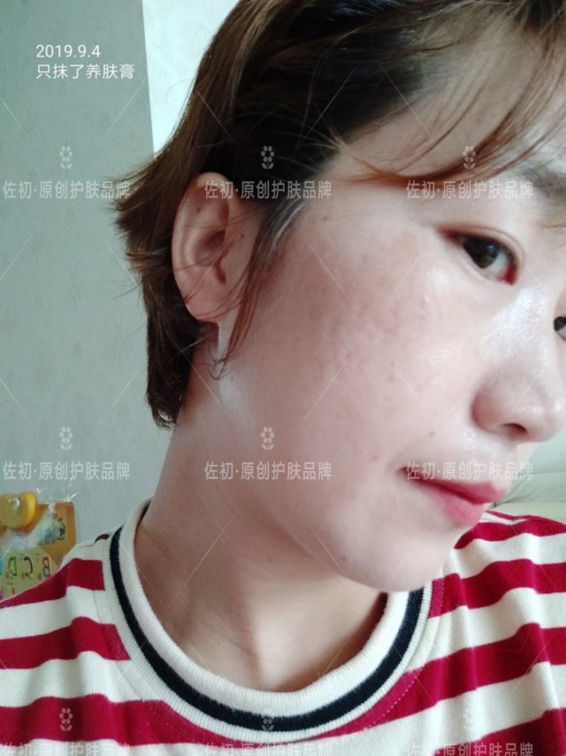 生完孩子烂脸,生完孩子脸上垮了怎样处理