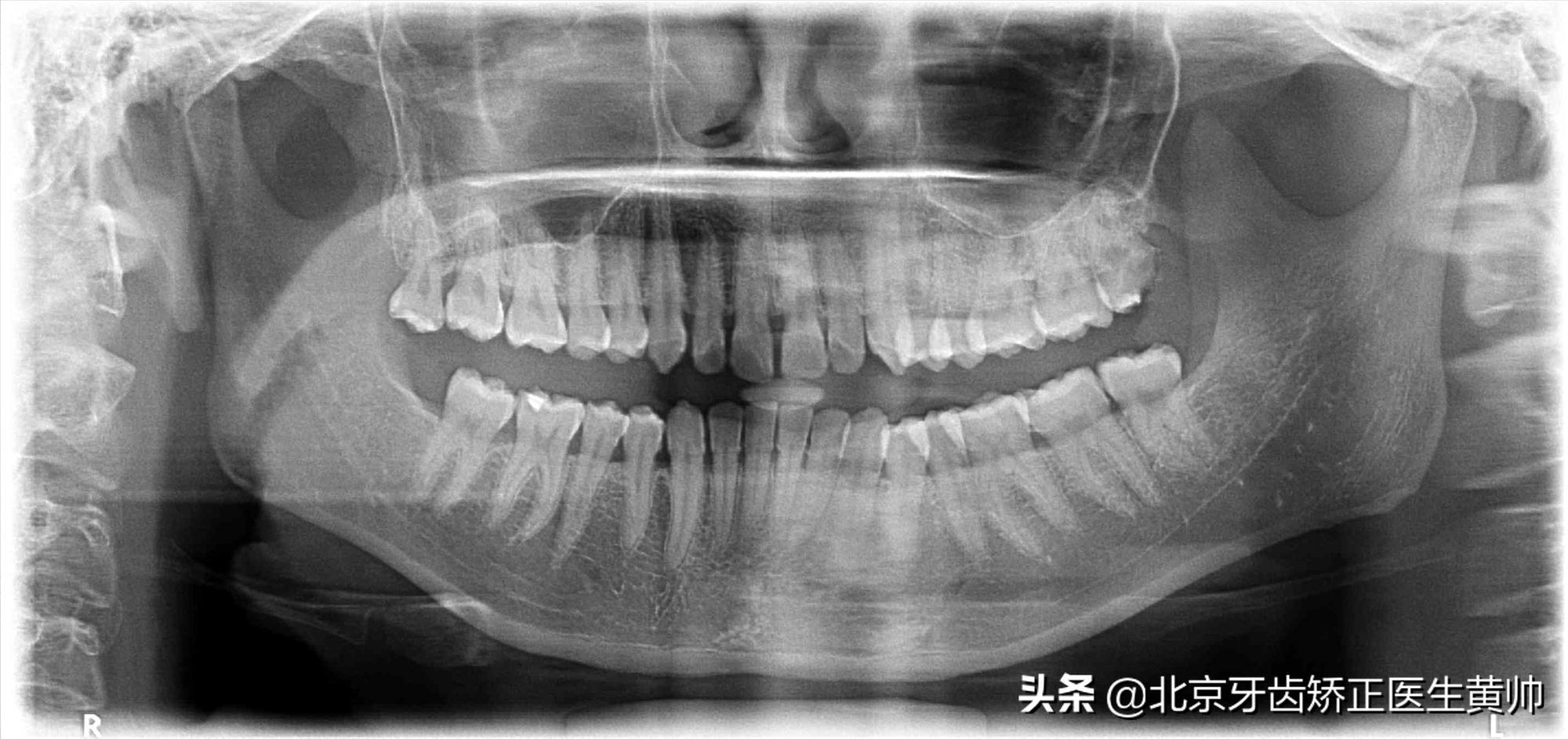 腺样体肥大牙齿矫正最佳年龄,儿童龅牙牙齿矫正最佳年龄
