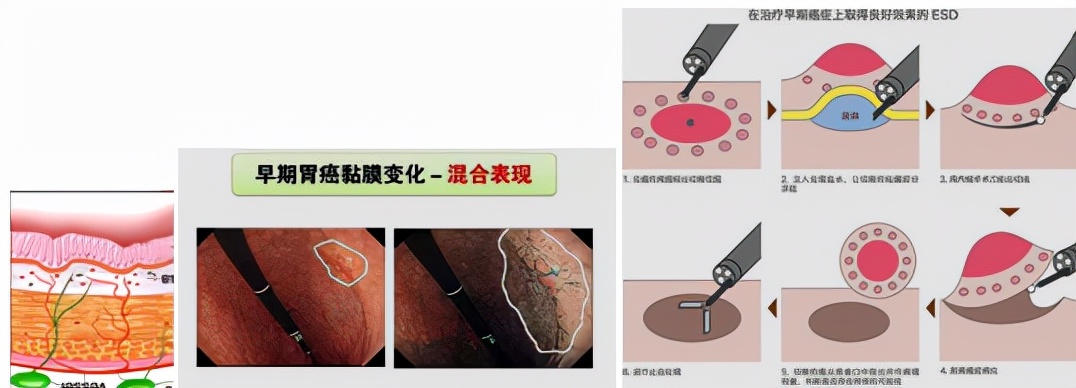 我不是药神,我不是财迷!若患胃癌,这些靶向药你有能力负担吗?