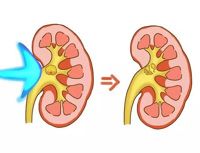 体外碎石治肾结石,结石体外碎石手术有效果吗