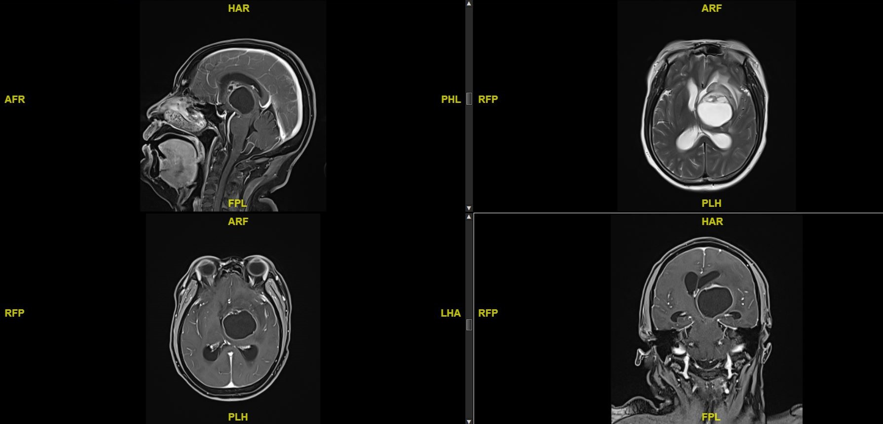 欧马亚囊（Ommaya囊）植入治疗巨大囊性脑转移瘤一例