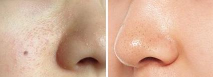 熬夜油皮肤毛孔粗大解决方法,毛孔粗大暗黄暗沉护肤克星