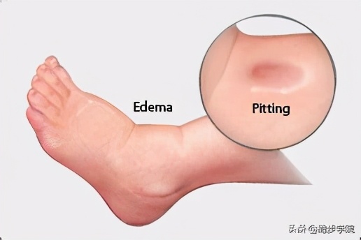 18岁运动时漏尿是怎么回事,运动不当引起茶色尿后自愈