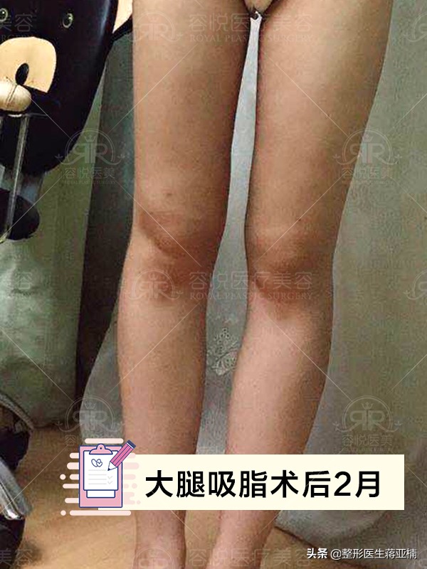腰腹吸脂后凹凸不平多久恢复,大腿吸脂多久会出现凹凸不平
