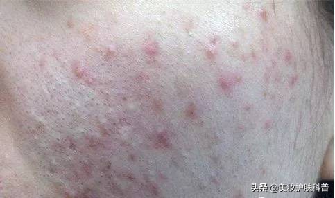 春暖花开过敏症状,春暖花开时预防过敏方法