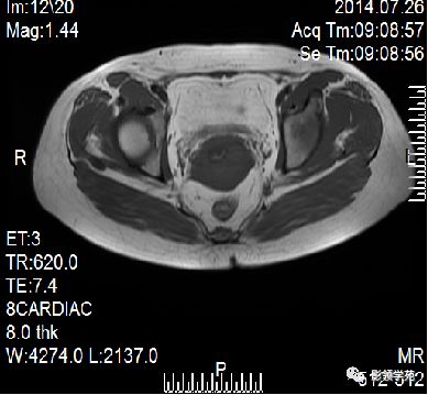 宫颈癌mri诊断,宫颈癌的mr扫描技术