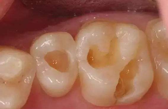 为何补牙反而要将牙洞磨大，补了之后要注意什么？听听牙医的意见