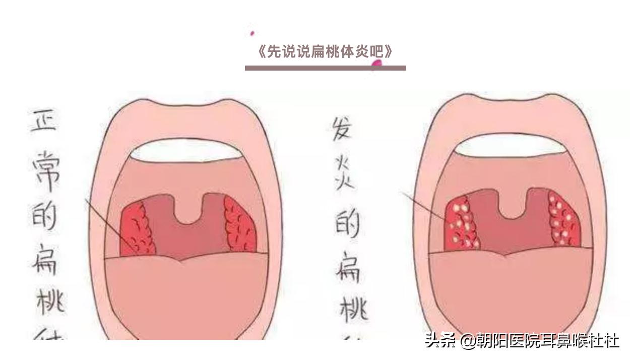 得了扁桃体癌的时候扁桃体红吗,扁桃体癌或扁桃体恶性淋巴瘤