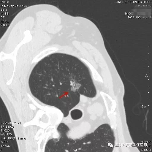 肺多发转移癌主要治疗手段,右肺上叶癌怎么治疗