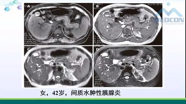 急性胰腺炎的护理措施,急性胰腺炎影像与临床