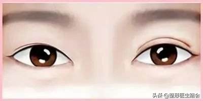 割双眼皮真的有效果吗,适合割双眼皮的眼部条件