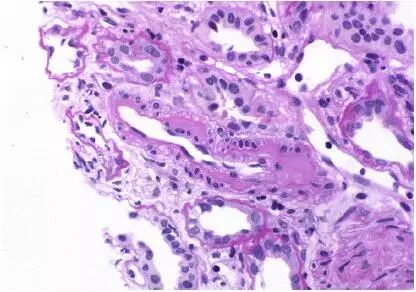 肾毒性食物一览表,肾毒性的药物排名