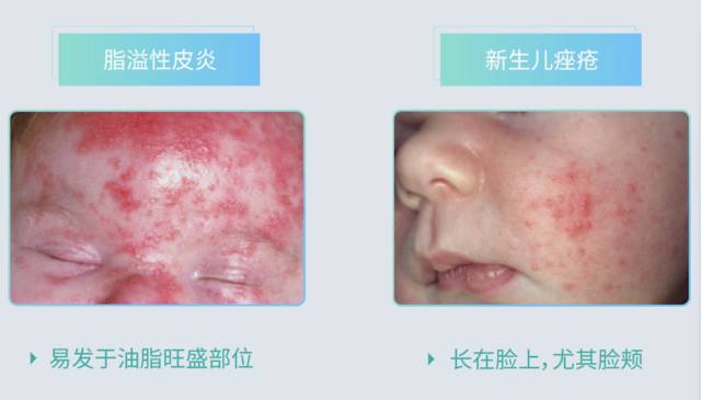 宝宝的疹子到底是什么原因？又该怎么护理？看这篇就够了