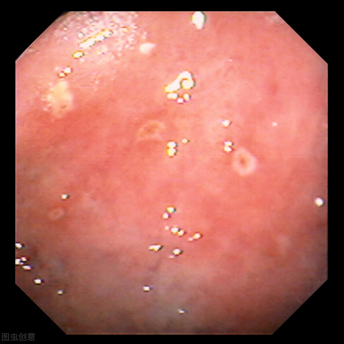 你做过胃镜检查吗,你有多久没有做过胃镜