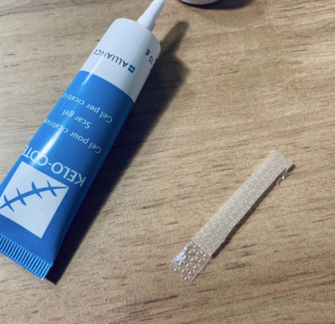 戚薇双眼皮修复视频完整版,戚薇肉条双眼皮是如何恢复的