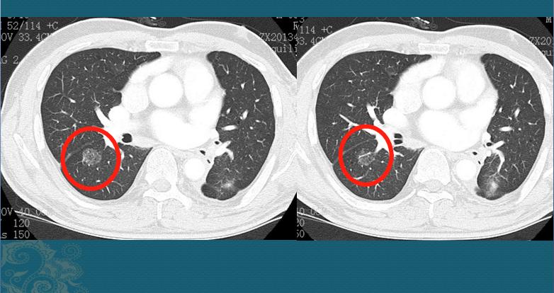 查出磨玻璃肺结节心里慌，该怎么做才保险？参考一下这6个