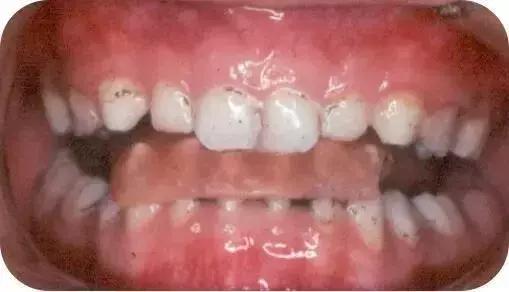 什么叫地包天怎么治疗,什么叫地包天能矫正吗