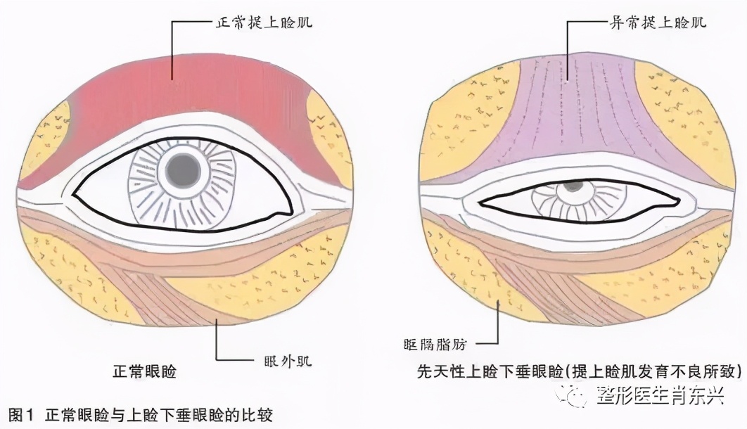 双眼皮埋线和割双眼皮有什么区别,除了割双眼皮怎么可以变成双眼皮