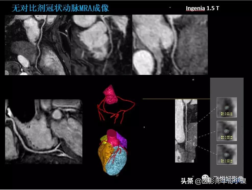飞利浦核磁共振快速扫描,飞利浦磁共振心脏扫描