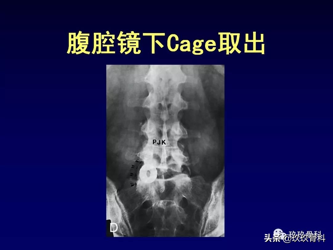 腰椎不稳最坏的结果,腰椎不稳的最佳治疗方法