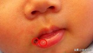口角炎防治小常识大全,健康科普口腔溃疡反复发作怎么办