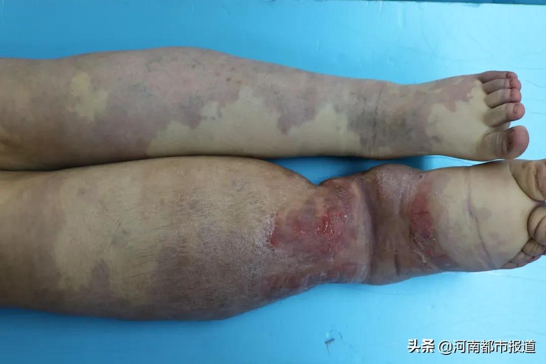 郑大一附院救大象,广西医科大救助小女孩