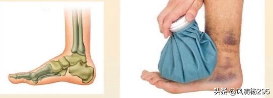 预防足底筋膜炎动作,足底跖筋膜炎症状及治疗