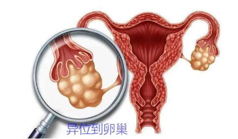 子宫内膜跑到卵巢里,子宫内膜跑了