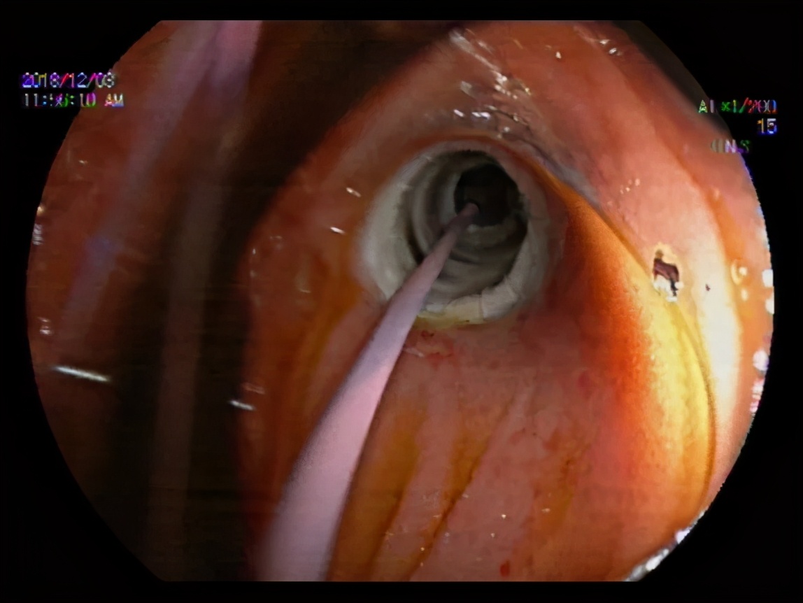 八年胆汁流通不畅,老奶奶成了“小黄人”……