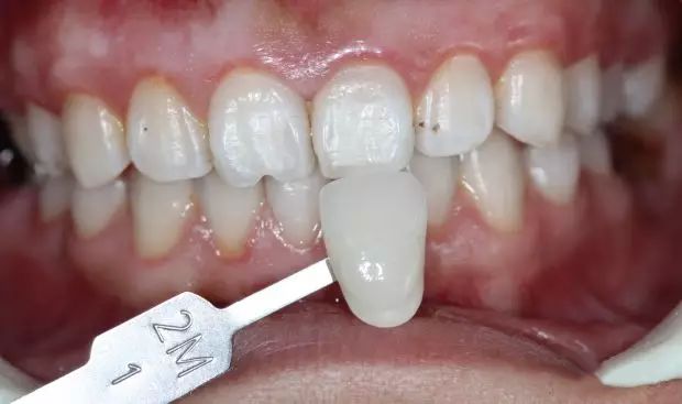 乳牙磕瓜子恒牙为什么变瓜子牙了,爱嗑瓜子